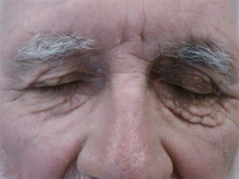 Syringoma (benign neoplasm of skin) - Dermatology Advisor