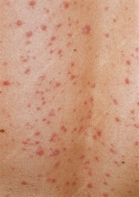 Guttate Psoriasis Skin Rash - Stock Image - M240 0356 - Science Photo C2B