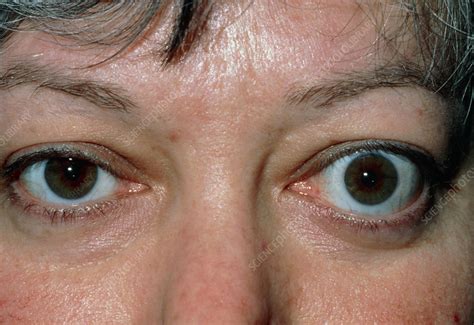 Bulging eye (exophthalmos) due to thyrotoxicosis - Stock Image - M270 ...