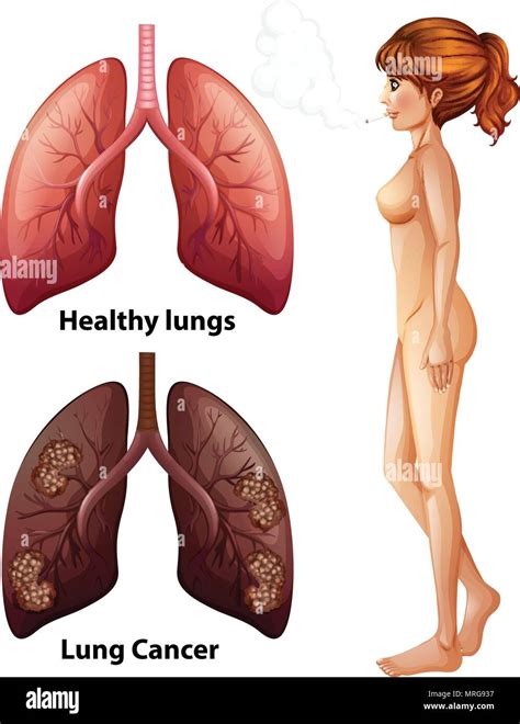 Human Anatomy Lung of Smoker illustration Stock Vector Image & Art - Alamy