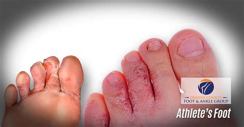 Pictures Of Athlete's Foot On Top Of Toes Flash Sales | emergencydentistry.com