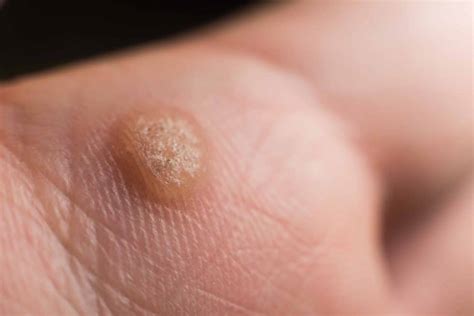 How to Get Rid of Warts?