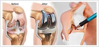 Knee replacement surgery cost in India – Ortho Joint