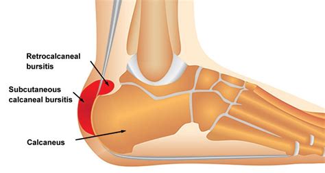 Achilles Tendon Bursitis