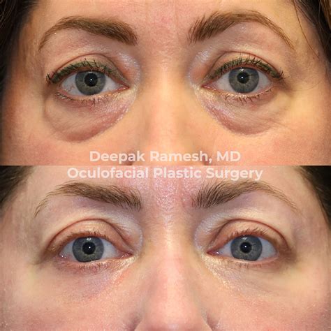 Eyelid Bag Surgery in Somerset, NJ | Dr. Deepak Ramesh