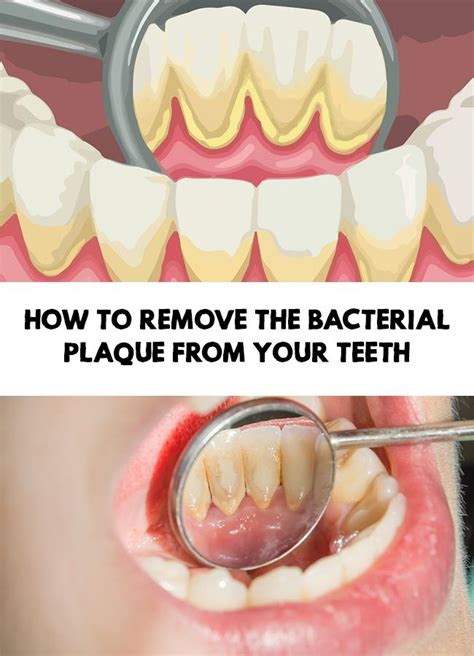 How to remove the bacterial plaque from your teeth | Bacterial plaque, Plaque teeth, Teeth ...