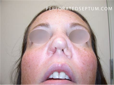 Perforated Septum, Dr. Hamilton - Surgical Repair of a Hole in the Septum