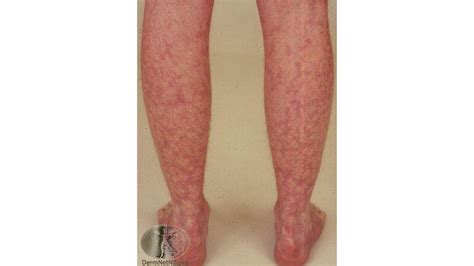 Mottled Skin (Livedo Reticularis): Causes, Signs, and Treatment