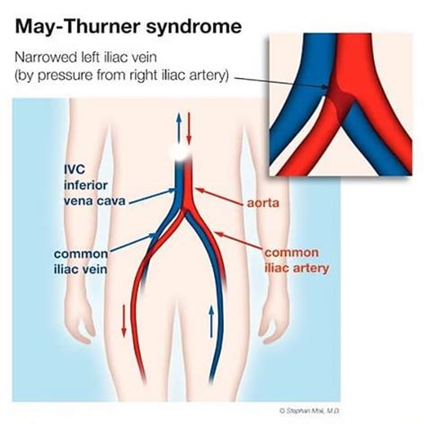 Peripheral Venous Disease - Center for Advanced Cardiac and Vascular Interventions