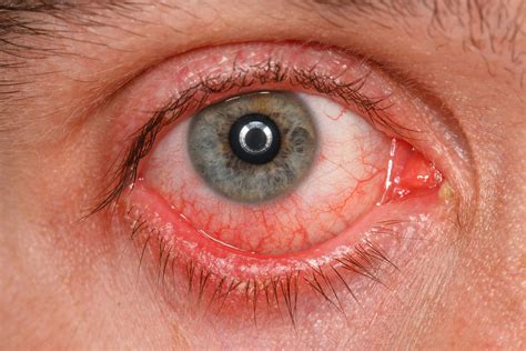 Case study: Conjunctivitis in atopic dermatitis