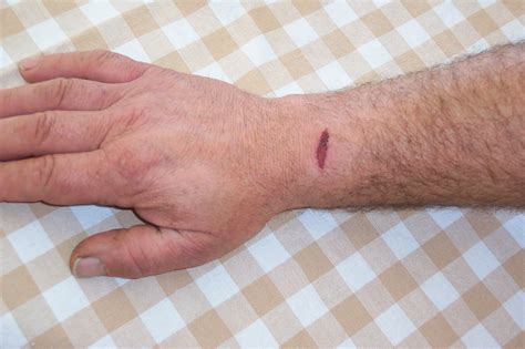 Gash Wound On Arm Free Stock Photo - Public Domain Pictures