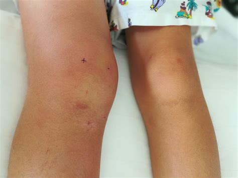 Swollen knee: Causes, treatments, and home remedies