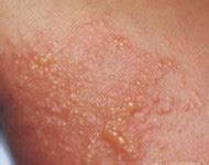 Eczema / Atopic dermatitis