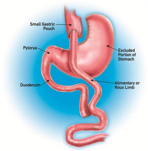 Gastric Bypass (RNY) Weight Loss Surgery in Dallas and Plano