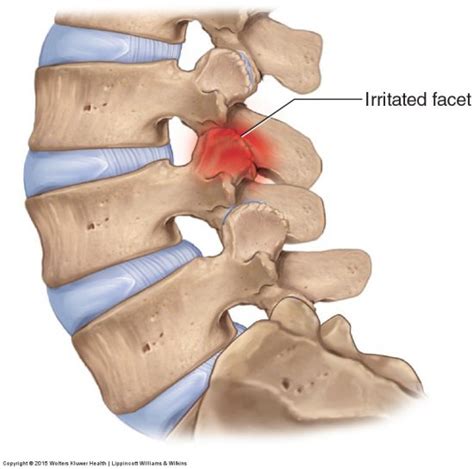 Facet Syndrome of the Lumbar Spine