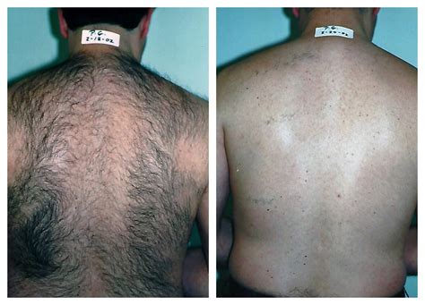 Laser Hair Removal for Men in Pittsburgh - Happel Laser Spa