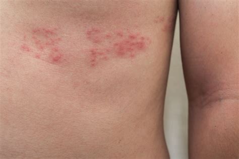 What is Shingles? - Elitecare Emergency Hospital