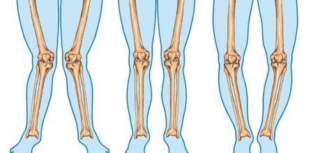 Genu valgo: Síntomas, causas y cómo tratar la enfermedad