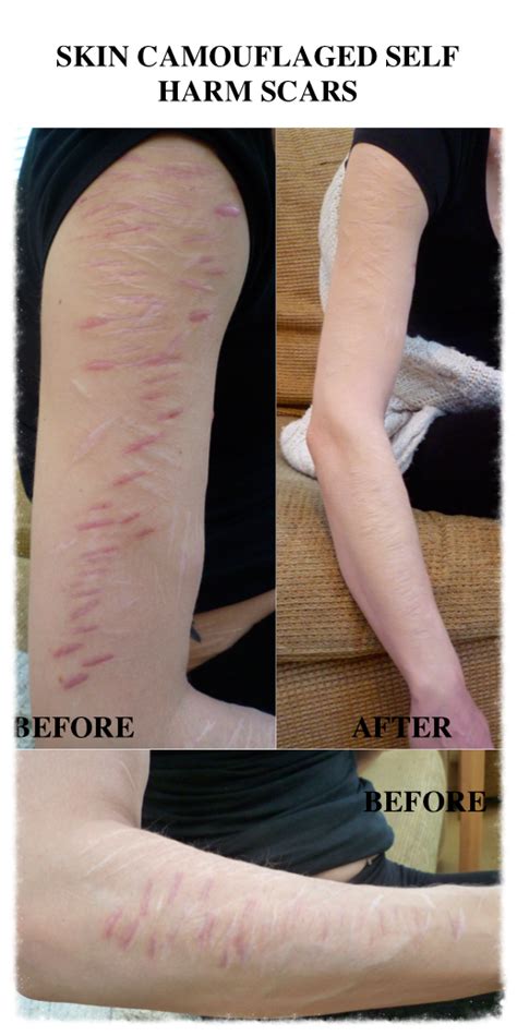 How To Hide Scars On Legs With Makeup | Saubhaya Makeup