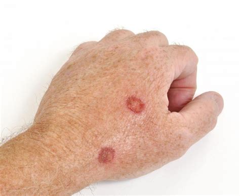 Figo! 15+ Elenchi di Melanoma Skin Cancer On Finger? Sunlight contains ultraviolet light that is ...
