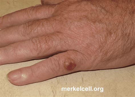 Symptoms of Merkel Cell Carcinoma