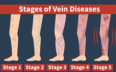 Vein Health: Lifestyle or Genetics? - Vein Specialists of the Carolinas