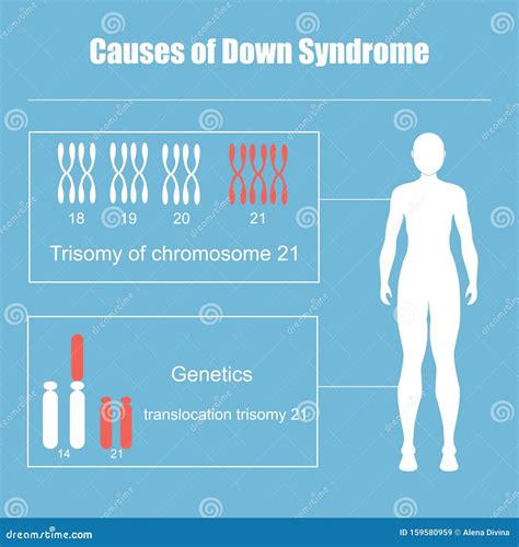 Causes of Down Syndrome stock vector. Illustration of congenital ...