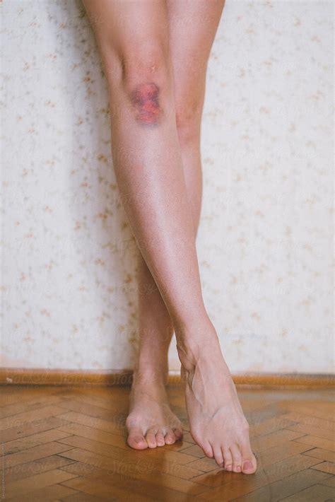 «Fresh Knee Bruises» del colaborador de Stocksy «Sanja (Lydia) Kulusic ...