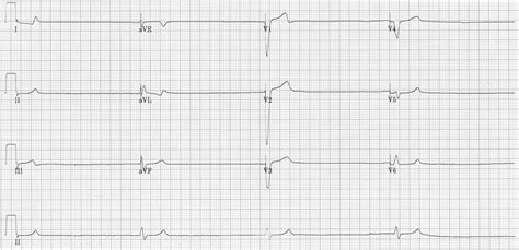 Ventricular Escape Rhythm • LITFL • ECG Library Diagnosis