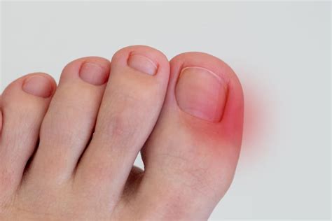 Toenail Falling Off? Here Are Its Causes, Management Tips And Recovery ...