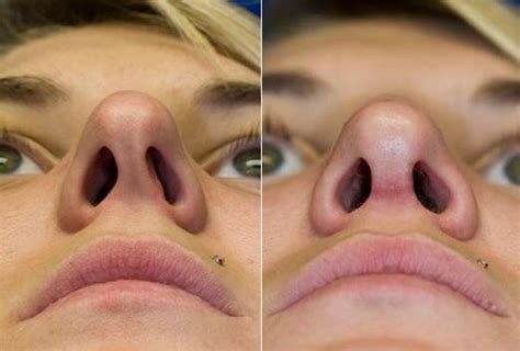 Everything You Need to Know About Functional #Rhinoplasty (#Septoplasty) -Via Thomas Lamperti ...