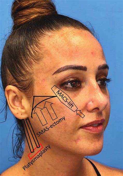 Illustration of face-lift procedure performed on study patients. Right ...