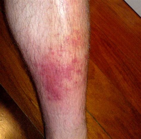 What is cellulitis - What causes cellulitis infection | the dynamic ...