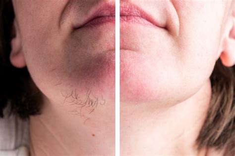 Your Options for Removing Those Annoying Chin Hairs - Healthgist