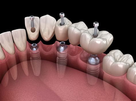 Supporting Dental Bridges With Implants | Santa Rosa, CA