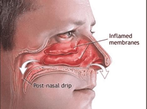 Inflamed Nasal Turbinates