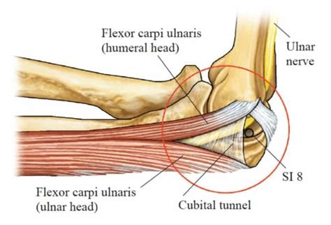 Ulnar Nerve Entrapment at the Elbow | AcuSport Education