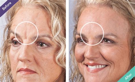 Wrinkle Fillers: An Alternative To Plastic Surgery – Bombay Cosmetic Clinic