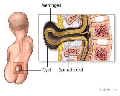 The New York Times > Health > Slide Show > Meningocele Repair > Slide 2 of 5