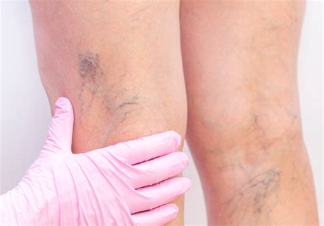 Understanding Spider and Thread Veins causes, treatments and measures