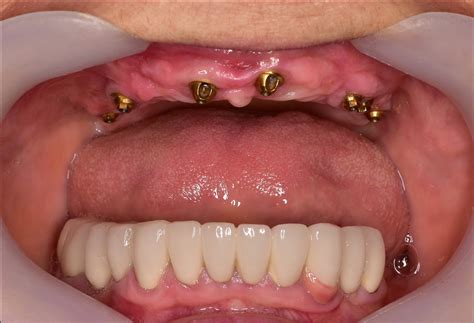 Fixed Implant Denture - Athens, GA | Watkinsville, GA — Hall Dental