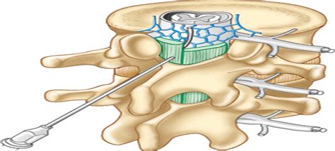 Epidural analgesia: What nurses need to know : Nursing2022