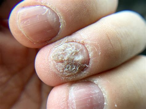 Nail Disorders | White Rock Dermatology