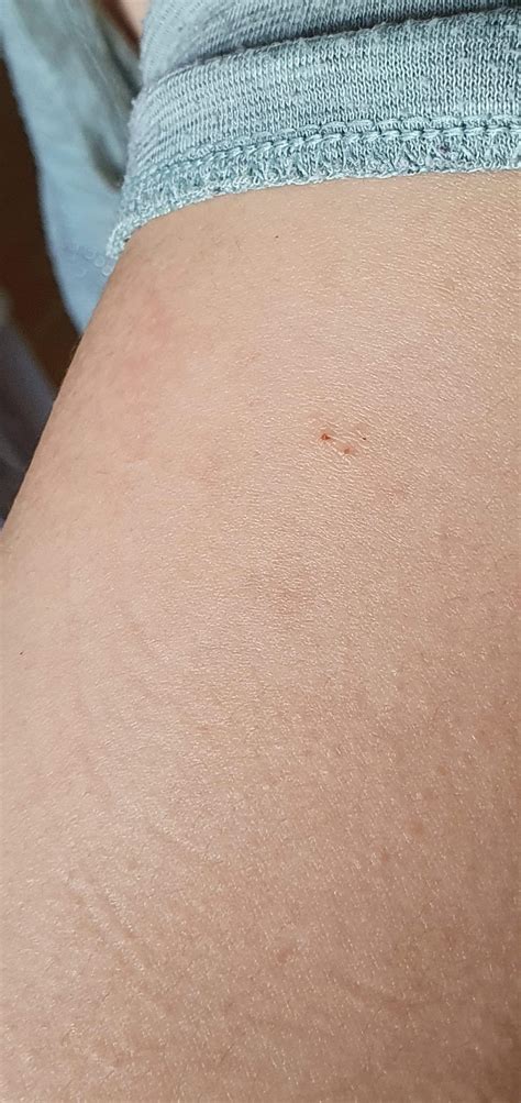 Need advice. Is this a bat bite? : r/batty