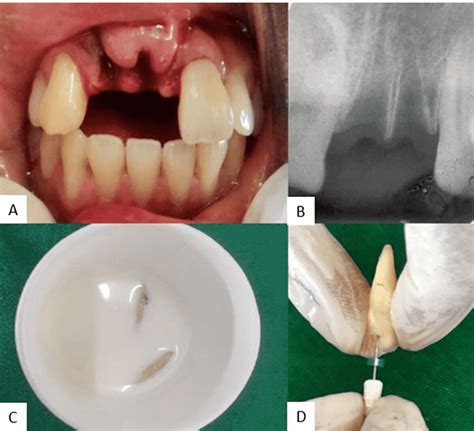 An Interdisciplinary Management of Avulsed Maxillary Incisors: A Case Report | Cureus