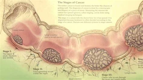 Colorectal Cancer Information