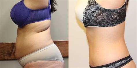 Tummy Tuck (Abdominoplasty) Before and After Photos - Dr Anzarut Plastic Surgery