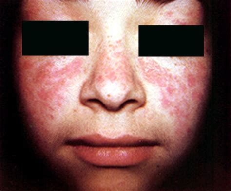 Systemic Lupus - Pictures