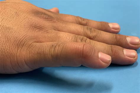 Mallet Finger – Hand Therapy Group