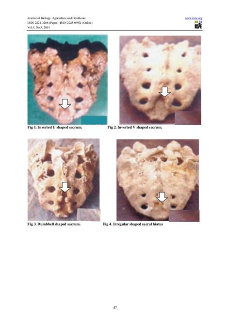 A study of sacral hiatus in dry human